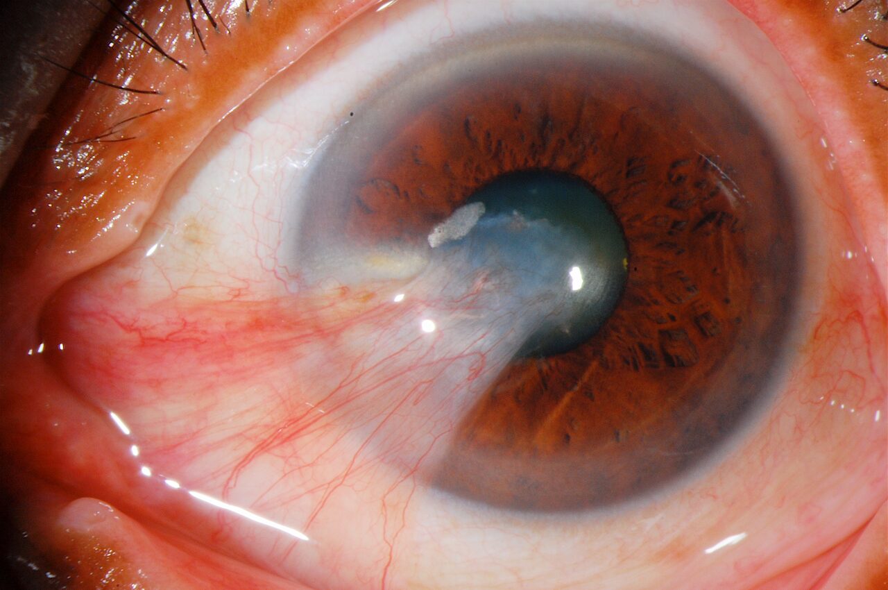 Pterjium (Gözde Et) Ameliyatı